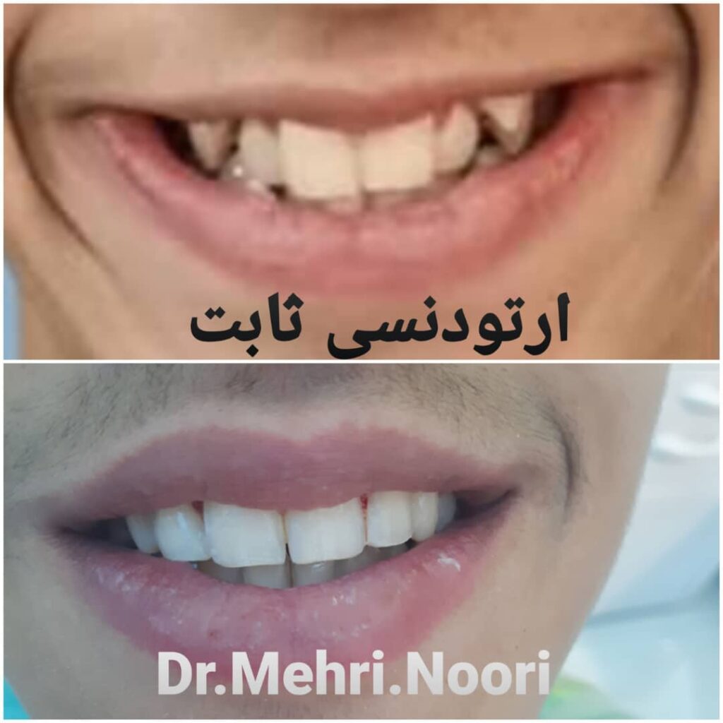 ارتودنسی ثابت | دکتر مهری نوری جراح و دندانپزشک